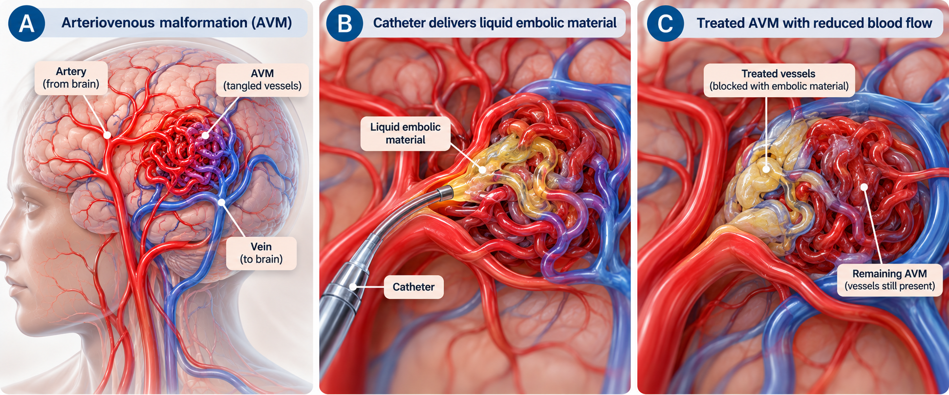Brain AVM Liquid Embolization